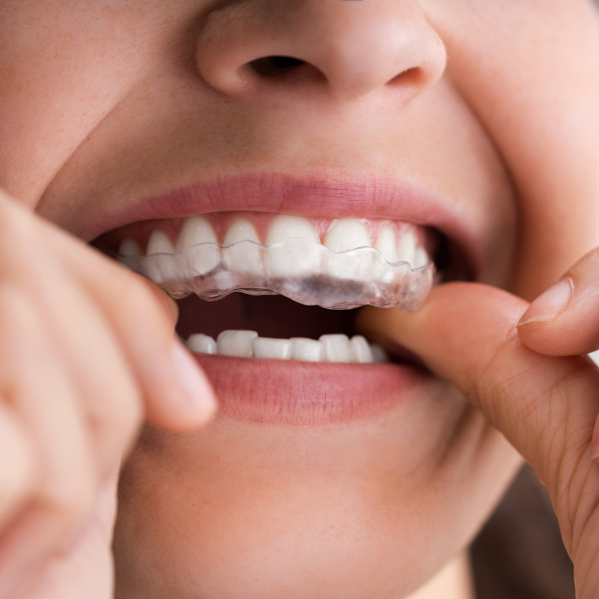Bruxismo clínica dental Redován